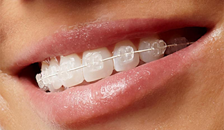 Clear Fixedbraces