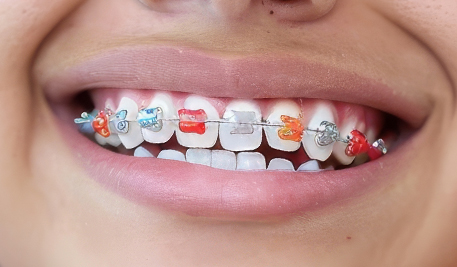 Coloured Fixed Braces