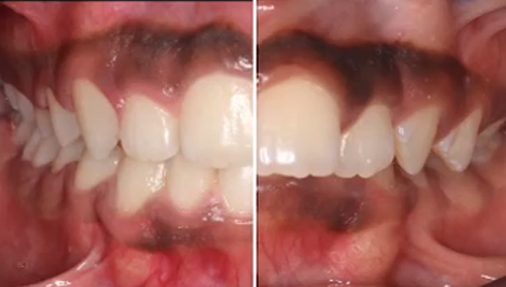 Invisalign treatment